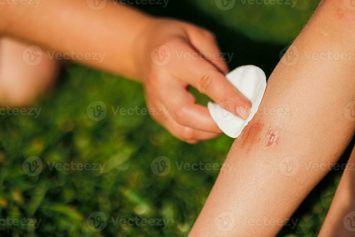 A woman's hand heals a child's wound below the knee. The child is sitting on the green grass in the summer. Treatment of the wound. First aid. Close-up photo