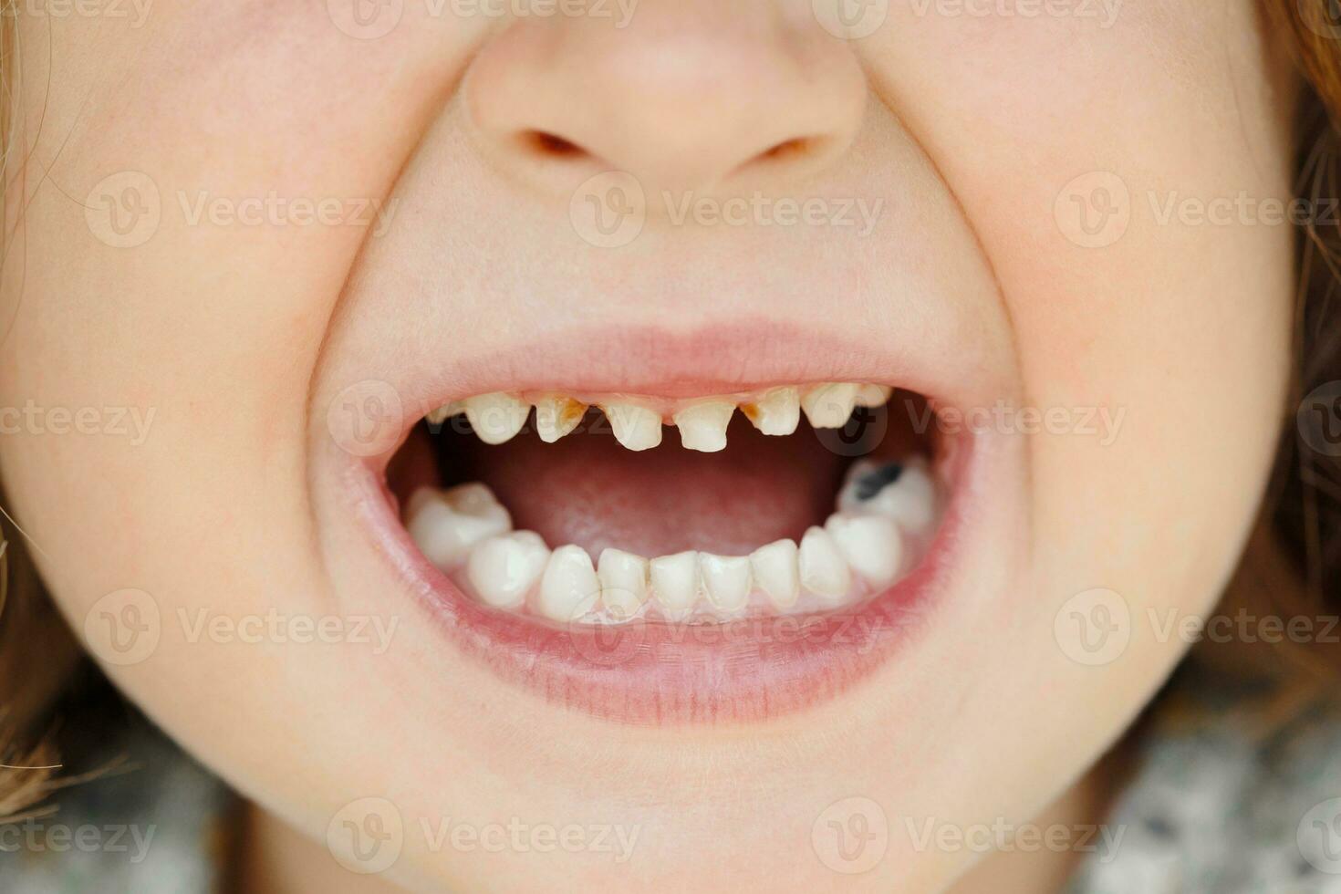 para niños Leche dientes con caries. de cerca de insalubre Leche dientes. dental medicina y cuidado de la salud - del paciente abierto boca demostración caries. para niños dentista. foto