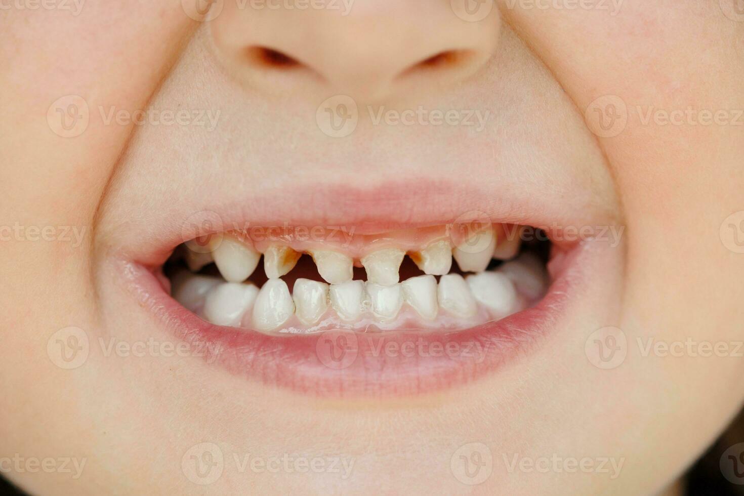 Children's milk teeth with caries. Close-up of unhealthy milk teeth. Dental medicine and healthcare - patient's open mouth showing caries. Children's dentist. photo