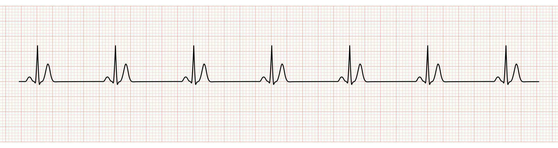 EKG Monitor Showing  Sinus Rhythm with Short QT interval vector