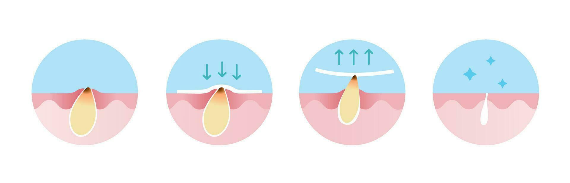 Step of blackhead removal vector icon set illustration isolated on white background. Cross section of blackhead treatment process, apply, peel off, unclogging and tighten pore.
