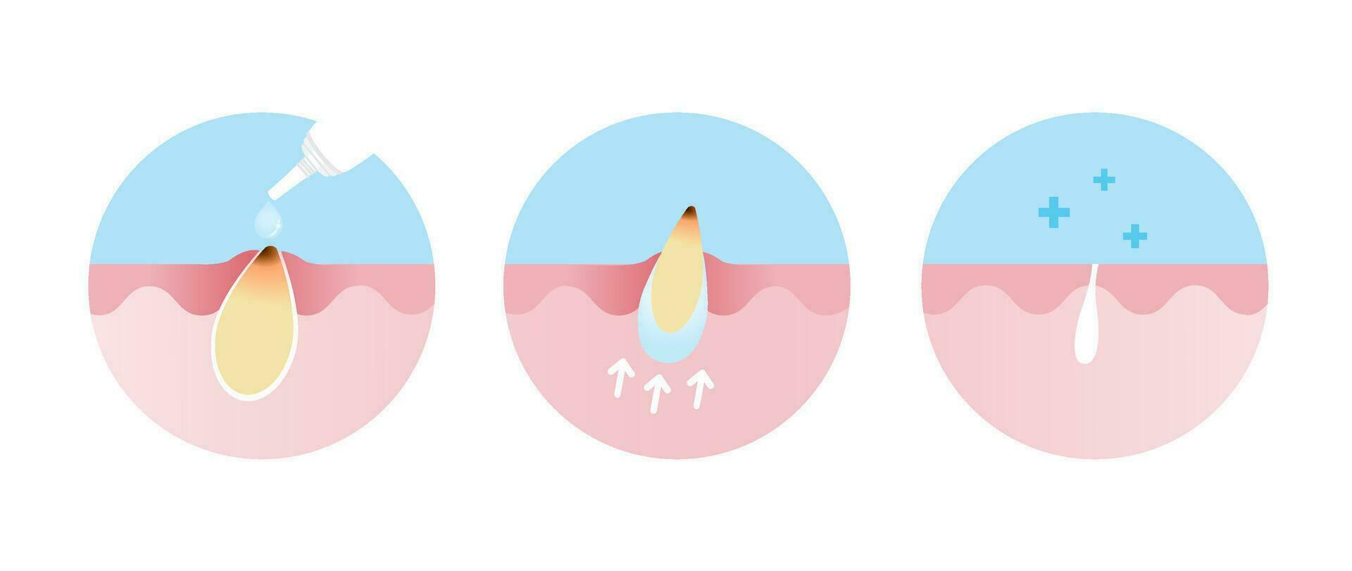 Blackhead treatment gel vector icon set illustration on white background. Cross section of use acne cream, reduce clogged pore, non inflammatory acne and tighten pore. Skin care and beauty concept.