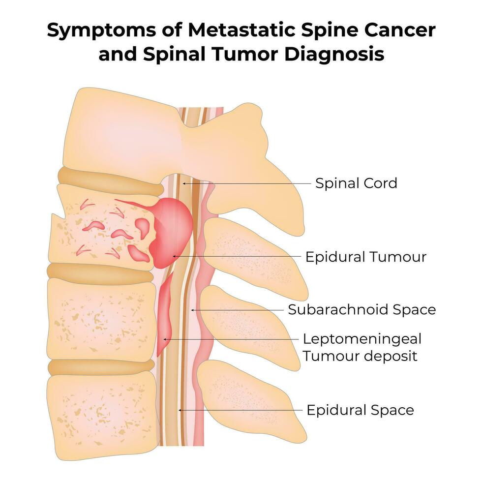 Symptoms of Metastatic Spine Cancer and Spinal Tumor Diagnosis Science Design Vector Illustration