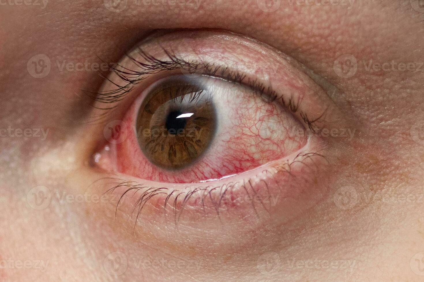 Red eye of a patient with conjunctivitis, close up photo