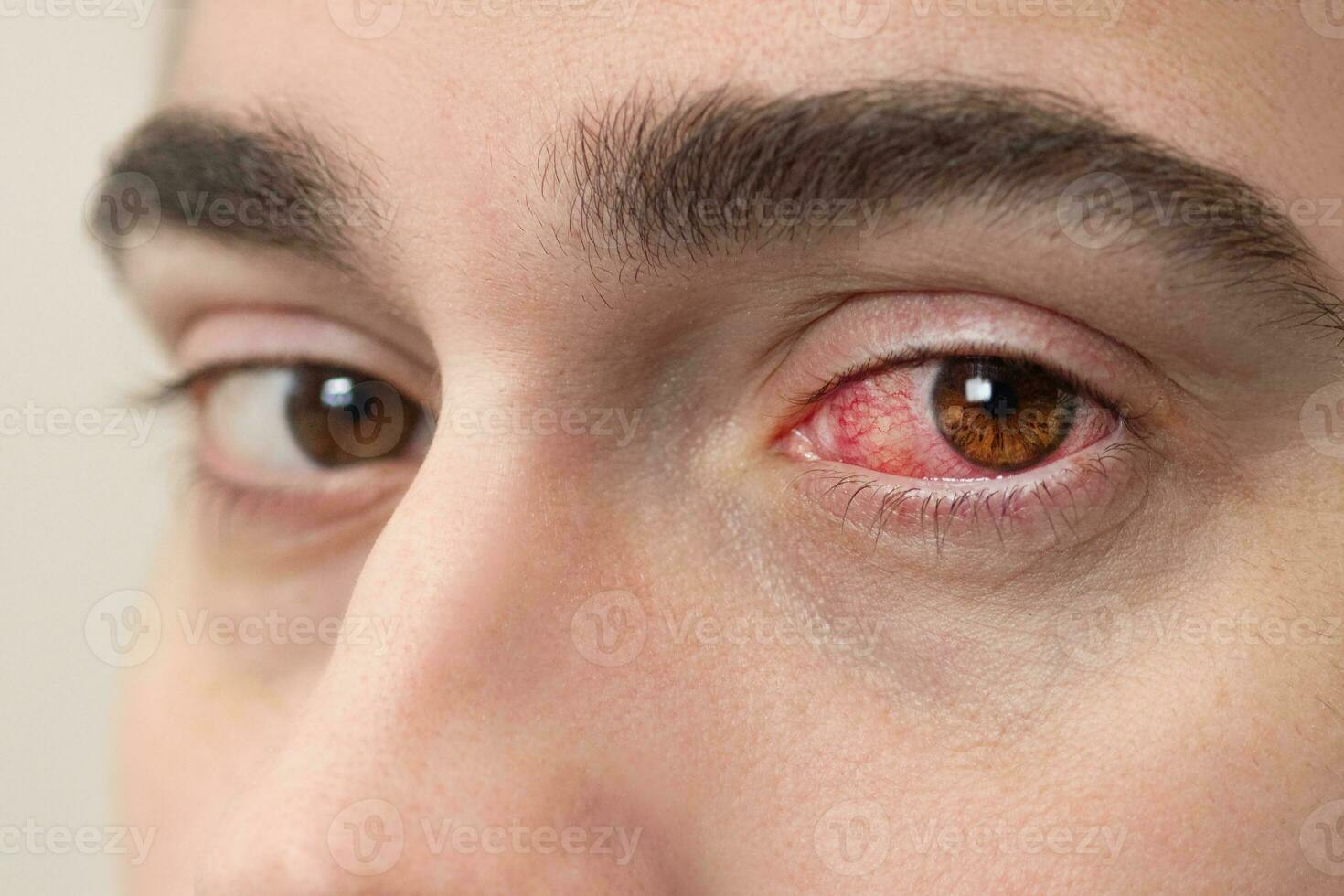 bloodshot-eyes-stock-photos-images-and-backgrounds-for-free-download