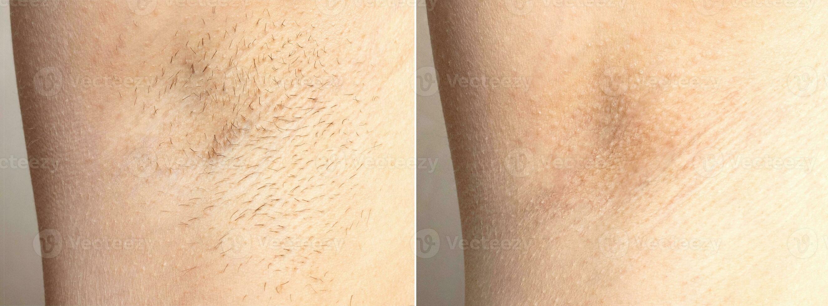 Collage before and after hair removal. hairy armpit female closeup dark hair growing under arm photo