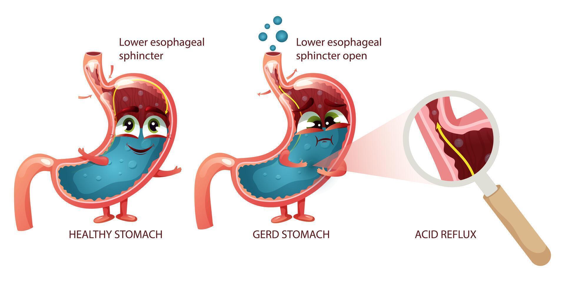 Stomach cartoon characters healthy and GERD with faces and emotions vector