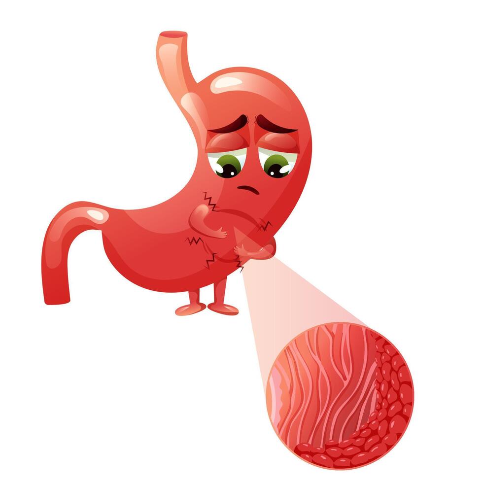 Sad cartoon stomach character with gastritis, inflammation in epithelial cells under magnification vector