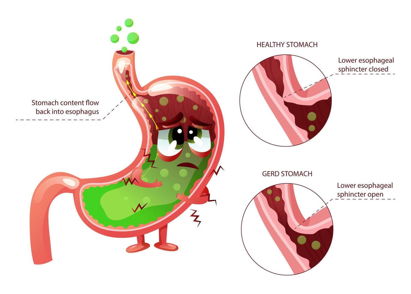 Gastroesophageal reflux disease GERD diagram with sad cartoon stomach character vector