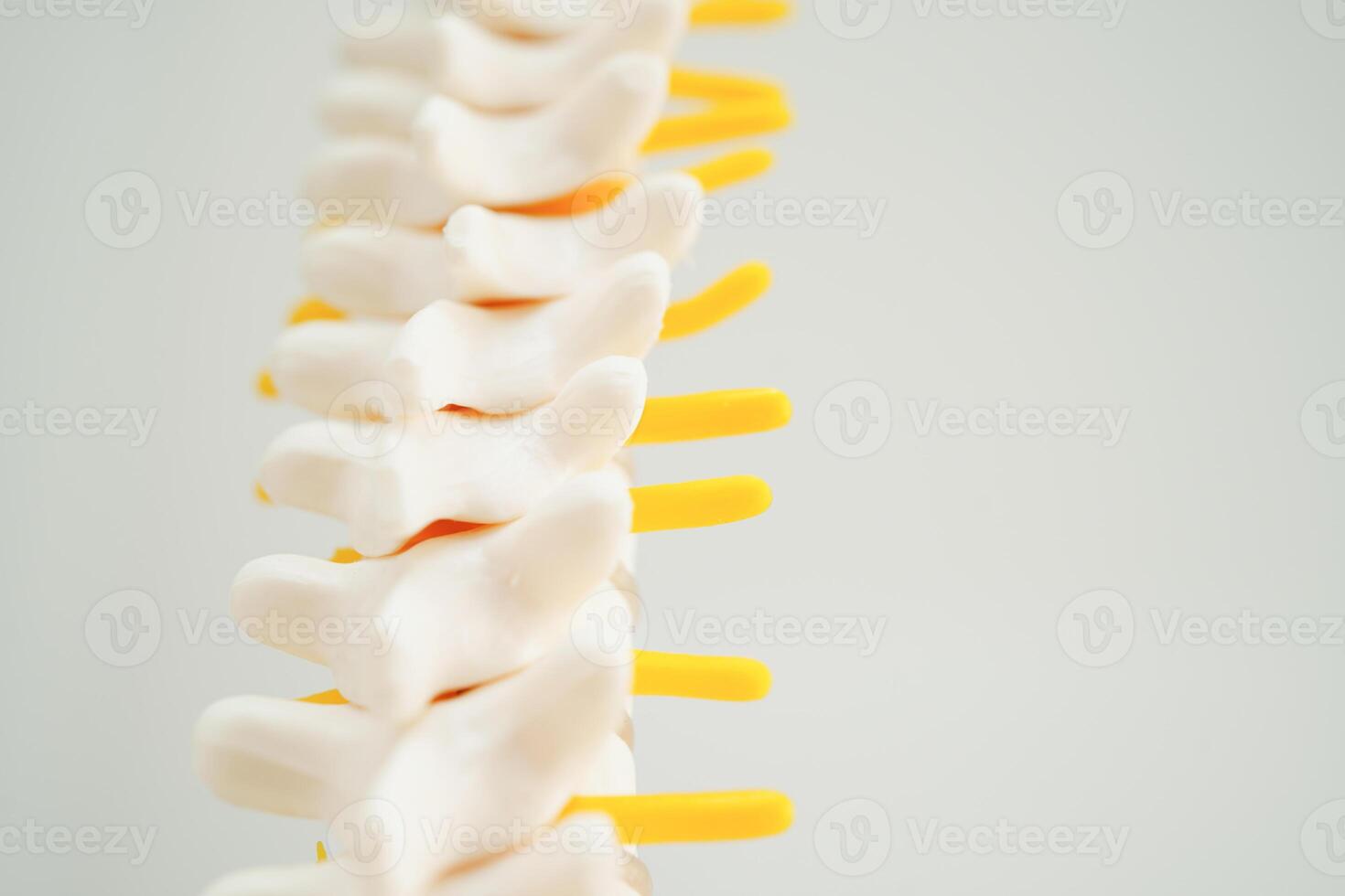 Spinal nerve and bone, Lumbar spine displaced herniated disc fragment, Model for treatment medical in the orthopedic department. photo