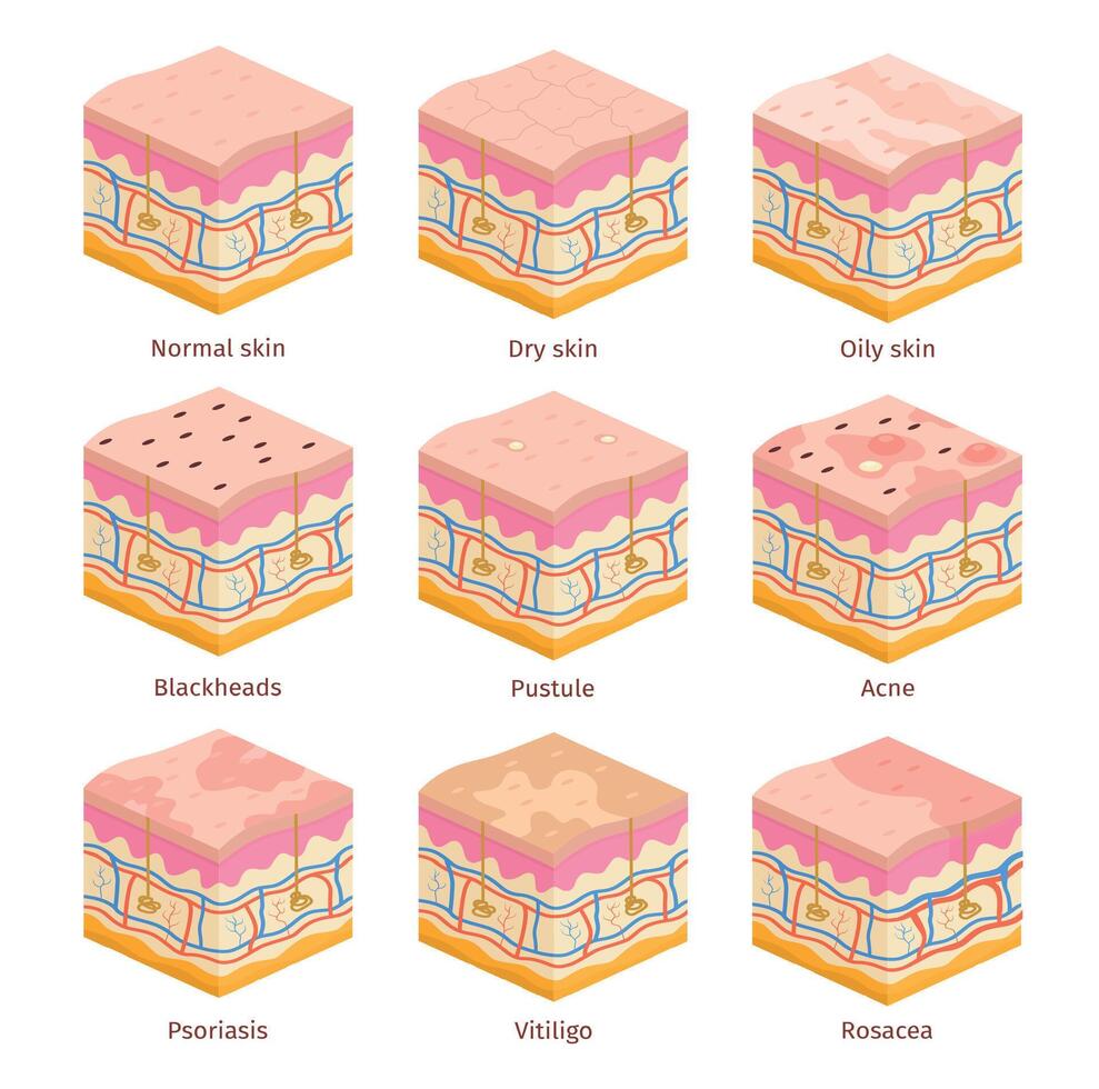 3d human skin types cross section layers. Dry, oily and normal epidermis. Skin problems, acne, blackheads, psoriasis and vitiligo vector set