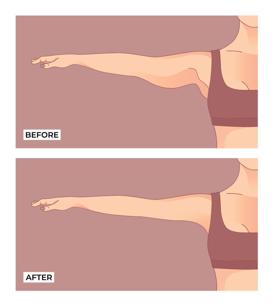 Arm fat. Before and after Brachioplasty, liposuction or plastic surgery, woman body shape transformation, Fat To Fit vector