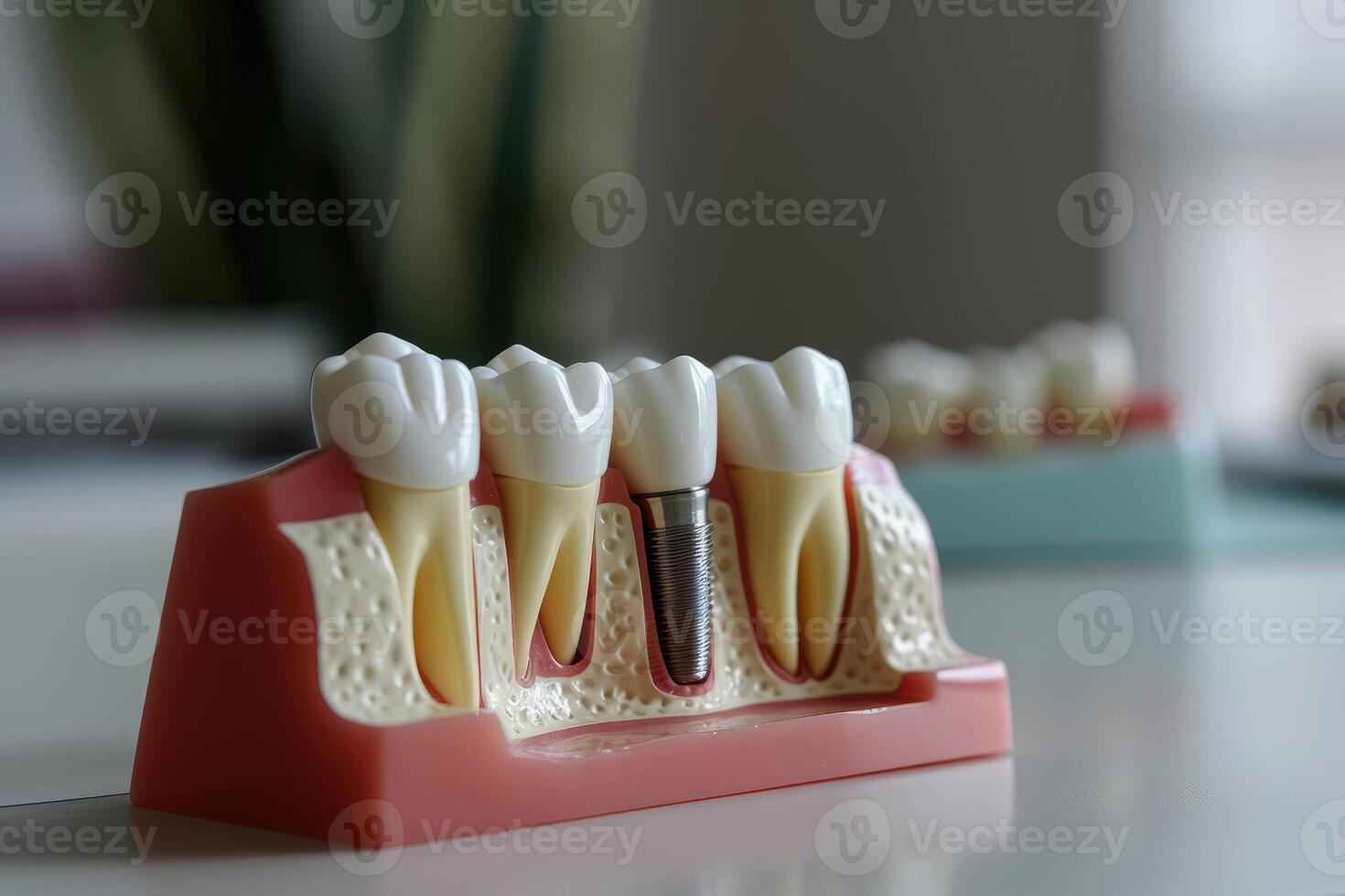 AI generated a model structure of teeth with an implant. AI generative photo