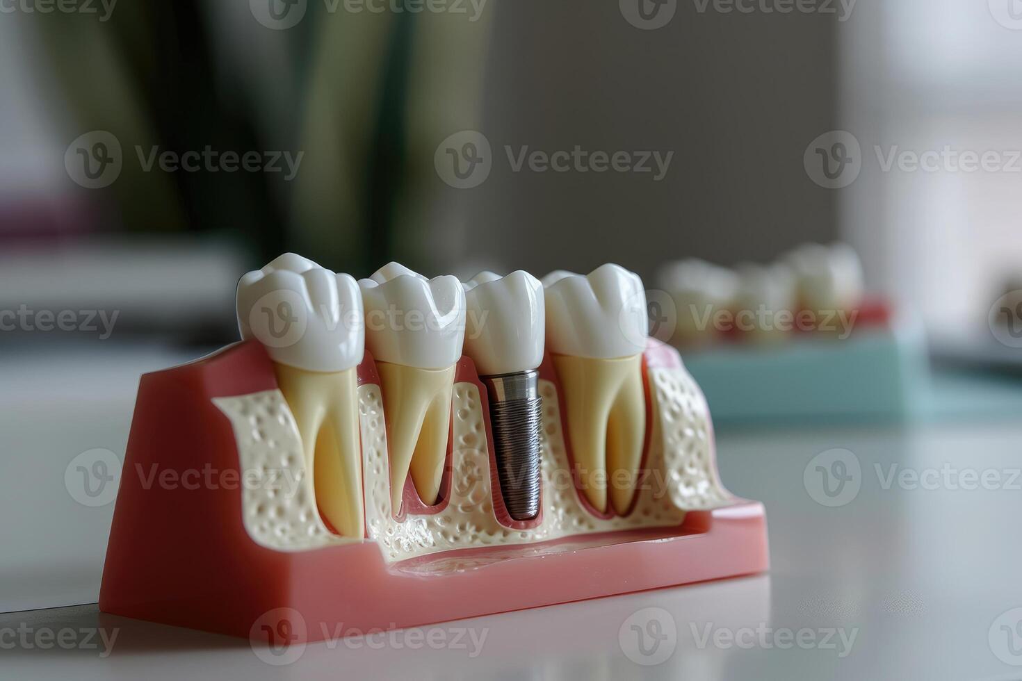 ai generado un modelo estructura de dientes con un implante. ai generativo foto