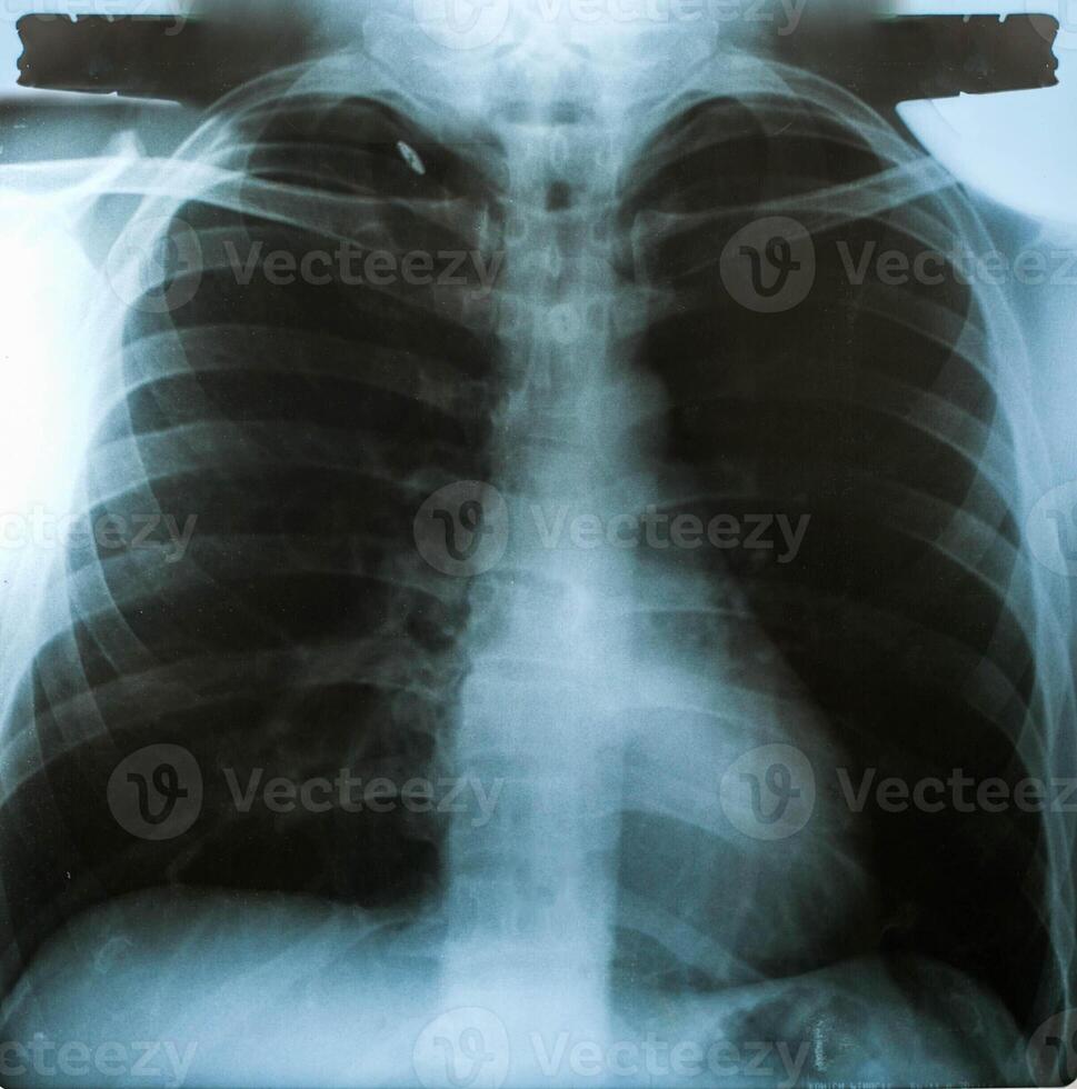 Imagen de rayos X, vista de hombres en el pecho para diagnóstico médico. foto