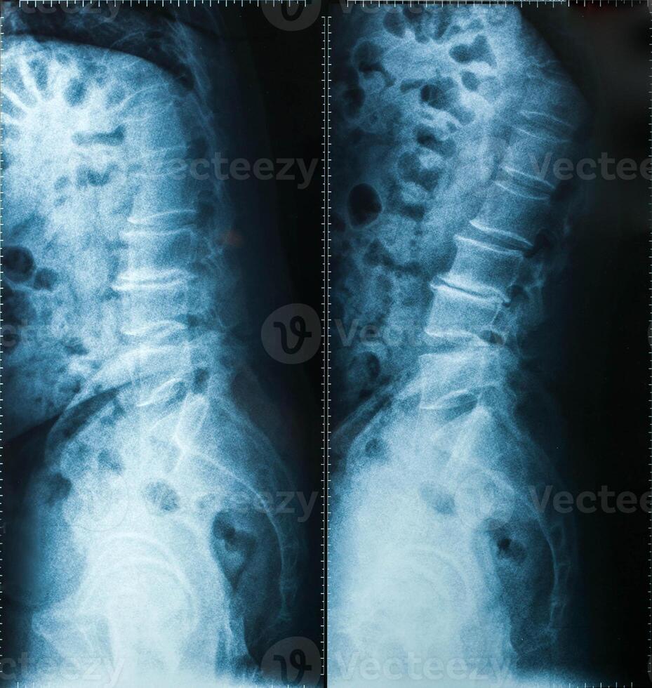 X-Ray image, View of neck men for medical diagnosis. photo