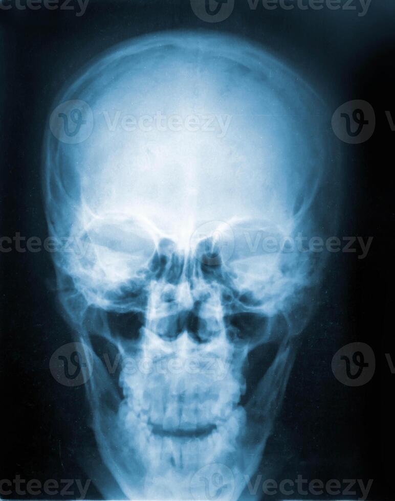 X-Ray image, View of skull men for medical diagnosis. photo