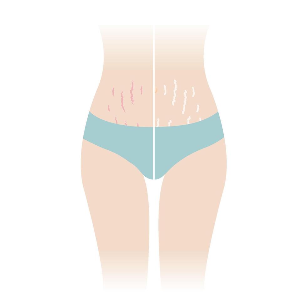 comparación de rojo y blanco tramo marcas en barriguita vector ilustración aislado en blanco antecedentes. el estrías rubras, estrías albae Aparecer en el abdomen, medio estómago, barriga frente de mujer cuerpo.