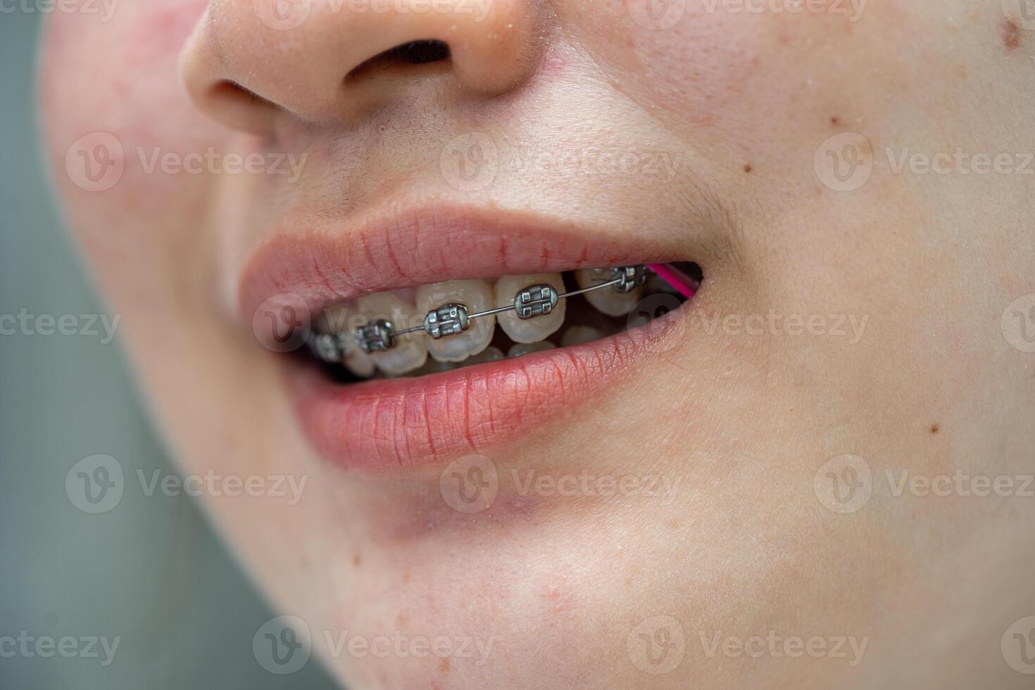 aparatos ortopédicos en la boca de una adolescente para tratar y embellecer para aumentar la confianza y la buena personalidad. foto