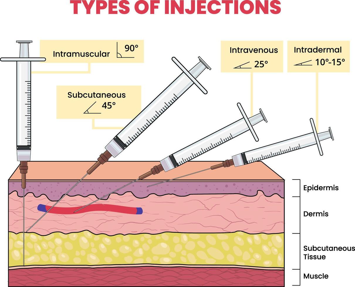 illustration of injection types infographic vector