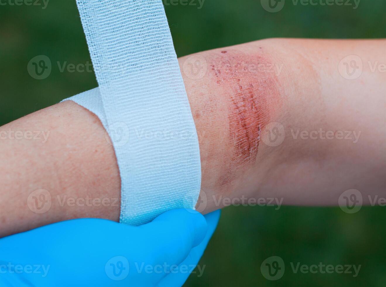 Doctor's hand healing a burned skin area photo