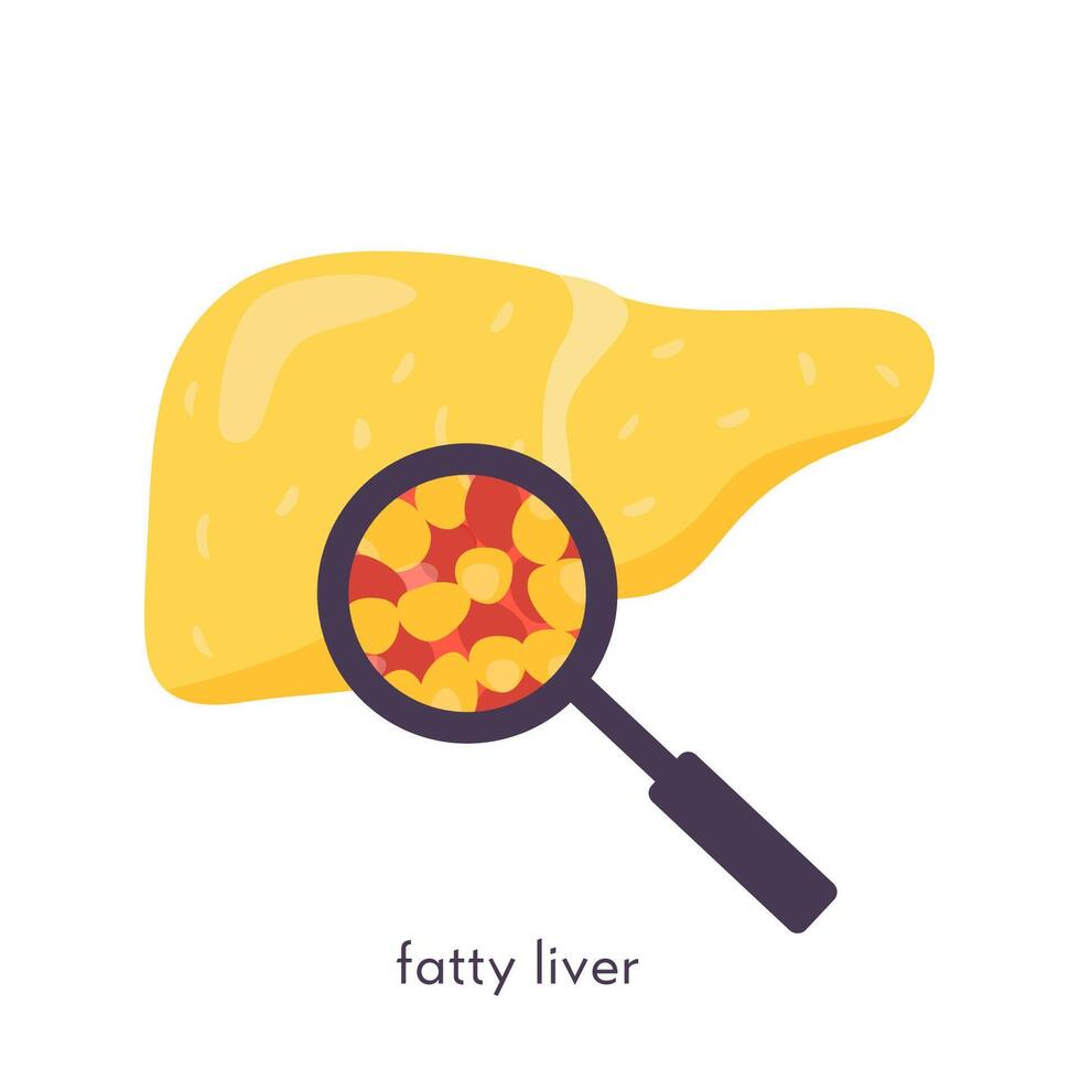 Stages of nonalcoholic liver damage. Healthy, fatty, steatosis, NASH, fibrosis, cirrhosis, cancer. Medical infographic of Liver Disease. Vector banner in flat cartoon style on white background.