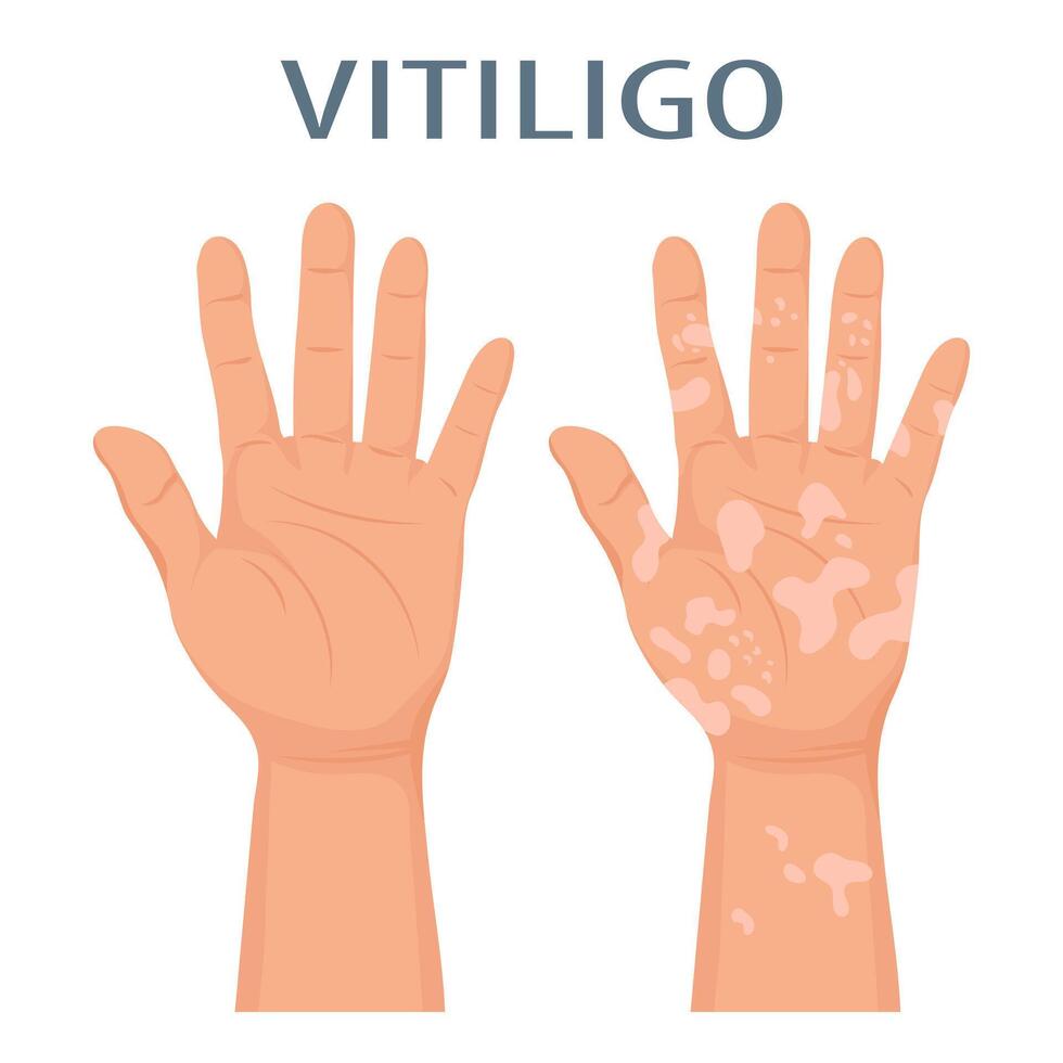 manos con dermatológico enfermedad vitíligo. medicina concepto. bandera, póster, vector