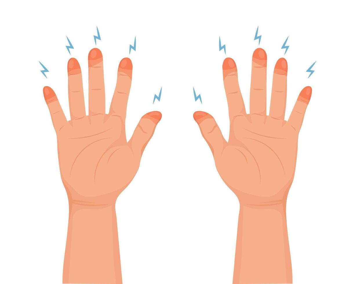 Frozen hands. Medical frostbite. Skin burn symptom. Health care medical concept. Vector
