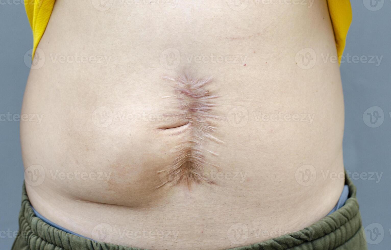 cicatriz después abdominal cirugía de un joven asiático hombre foto