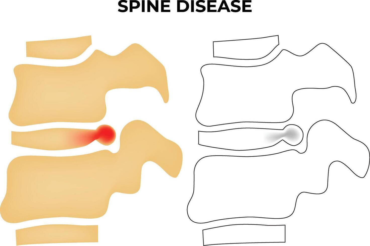 Spine Disease Science Design Vector Illustration Diagram