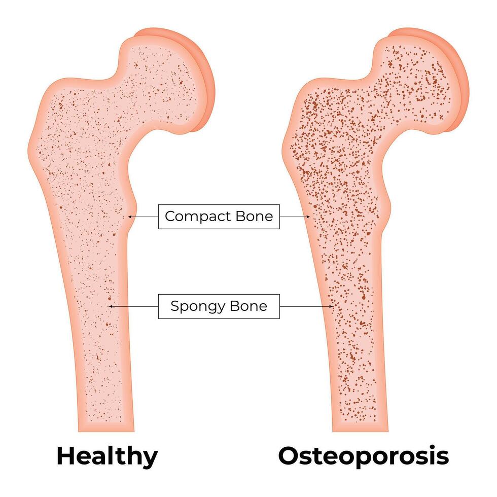 sano osteoporosis hueso Ciencias diseño vector ilustración diagrama