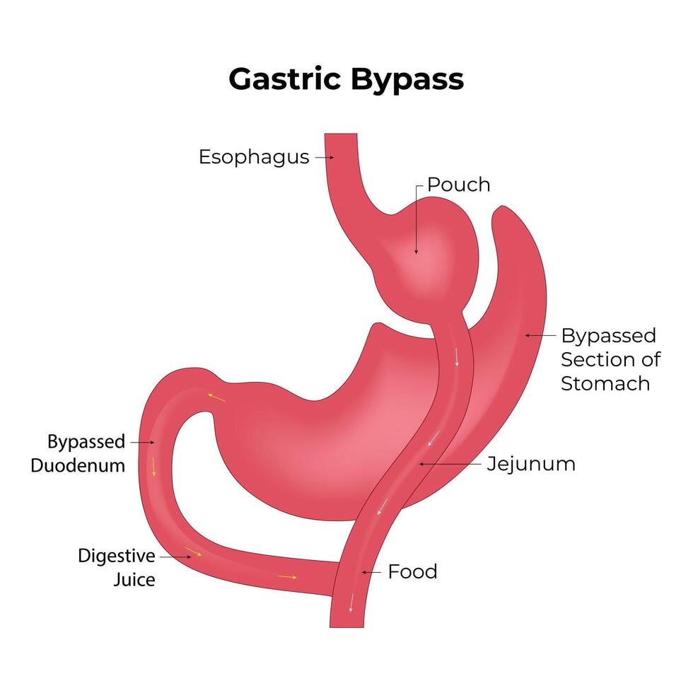 Gastric Bypass Science Design Vector Illustration Diagram