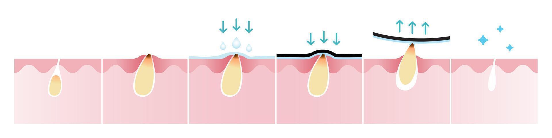 cruzar sección de espinilla acné y cómo a eliminar espinilla vector aislado en blanco antecedentes. mojado el piel, aplicar, pelar apagado, desatascar y apretar poro. piel cuidado y belleza concepto ilustración.