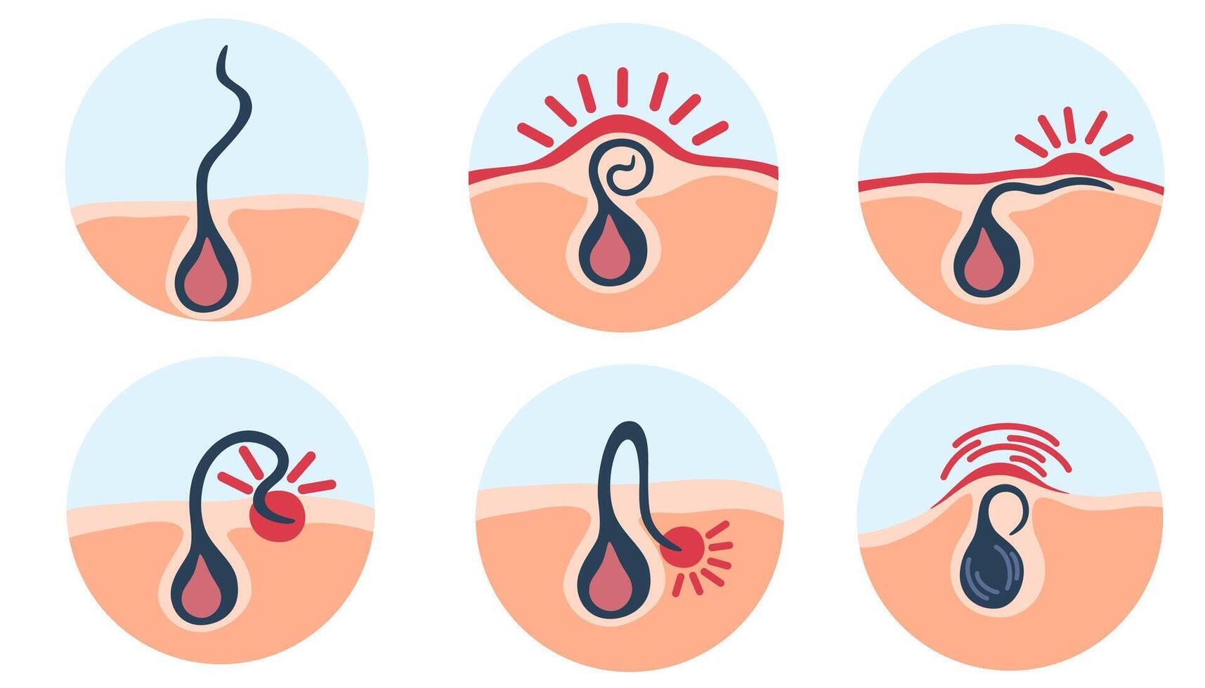 Ingrown hair. Hair has grown back into the skin surface after shaving. Inflamed follicle. Shaving concept. Vector illustration with problems after depilation.