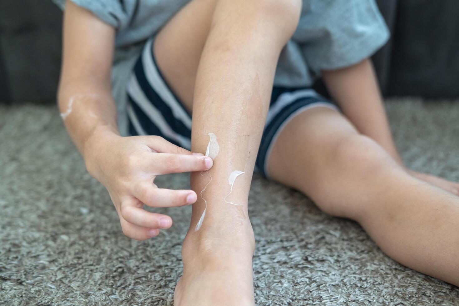 pequeño asiático Niños manos peladura apagado seco piel en su piernas. piel problemas. foto