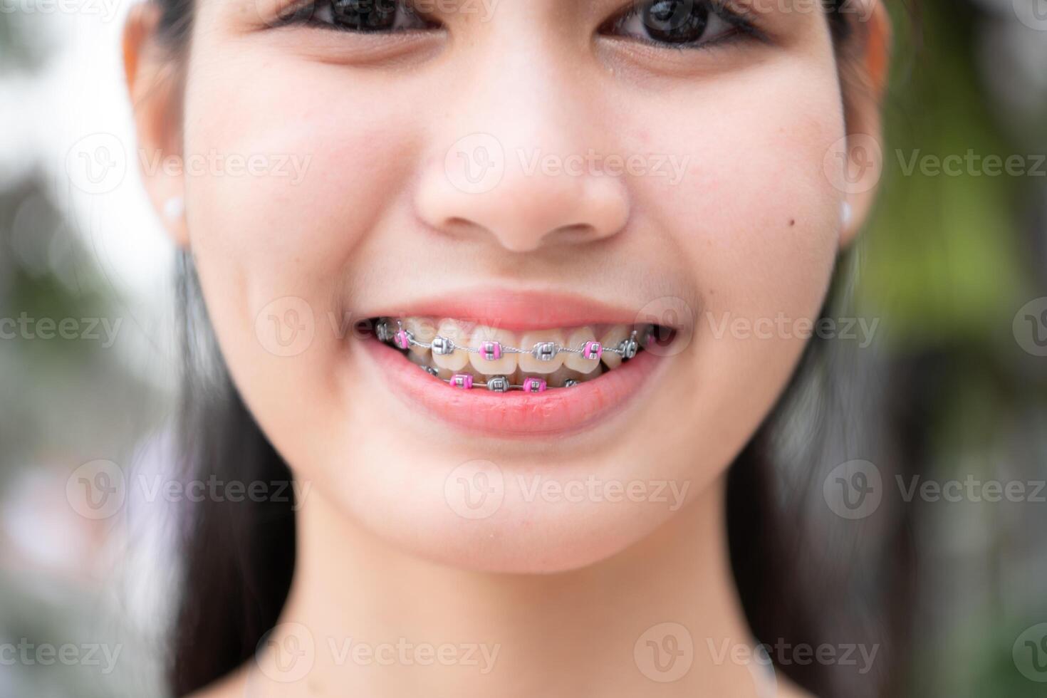 Portrait of a young asian woman with braces on her teeth photo