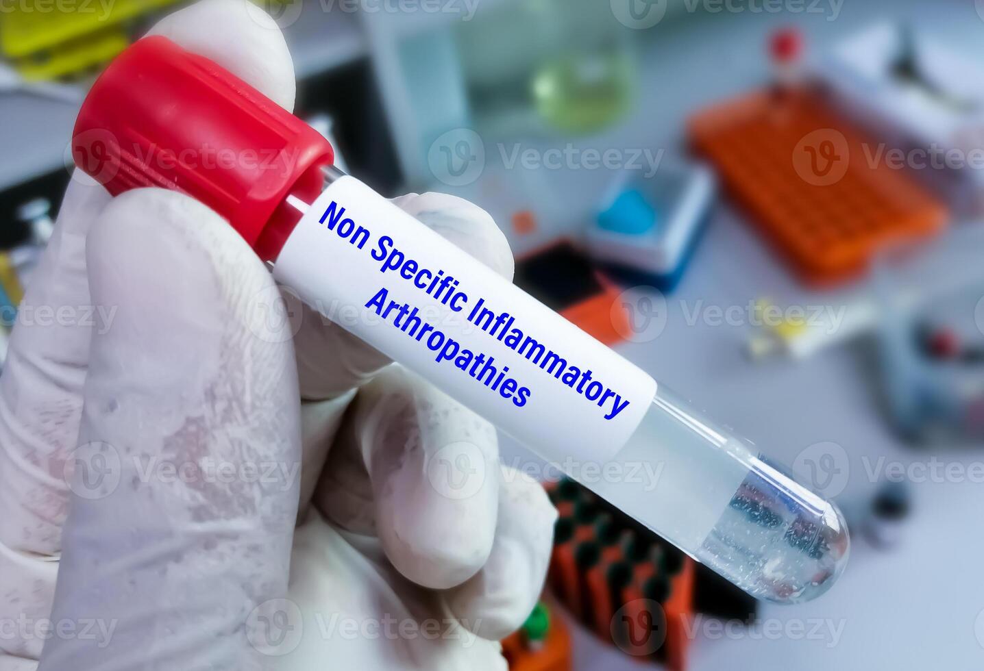 Synovial fluid analysis for Non Specific Inflammatory Arthropathies or Undifferentiated arthritis Test. photo