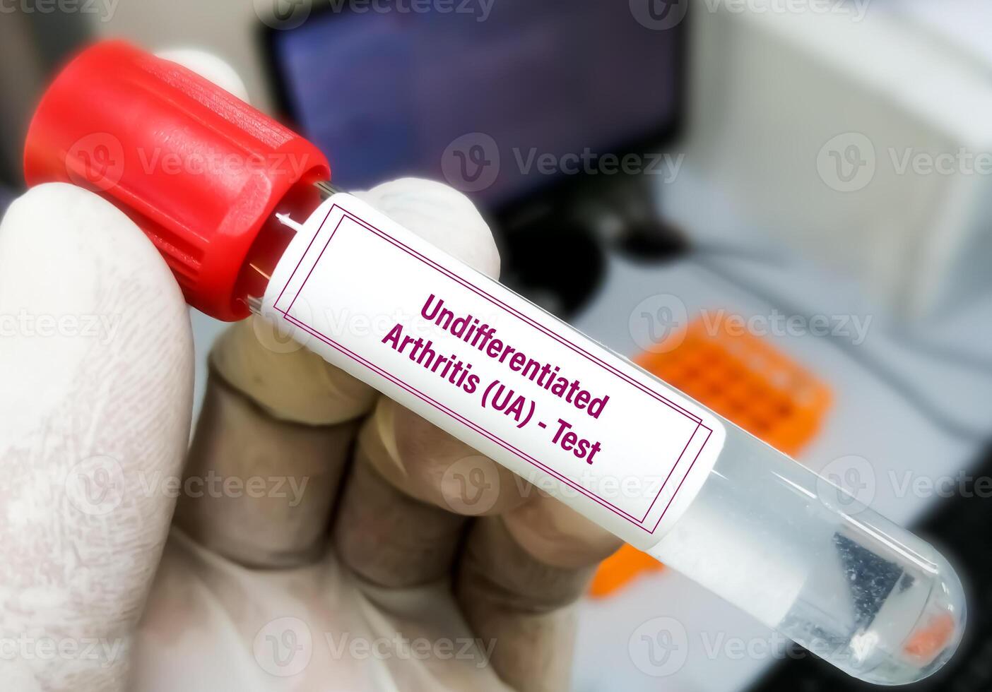Synovial fluid analysis for Non Specific Inflammatory Arthropathies or Undifferentiated arthritis Test. photo