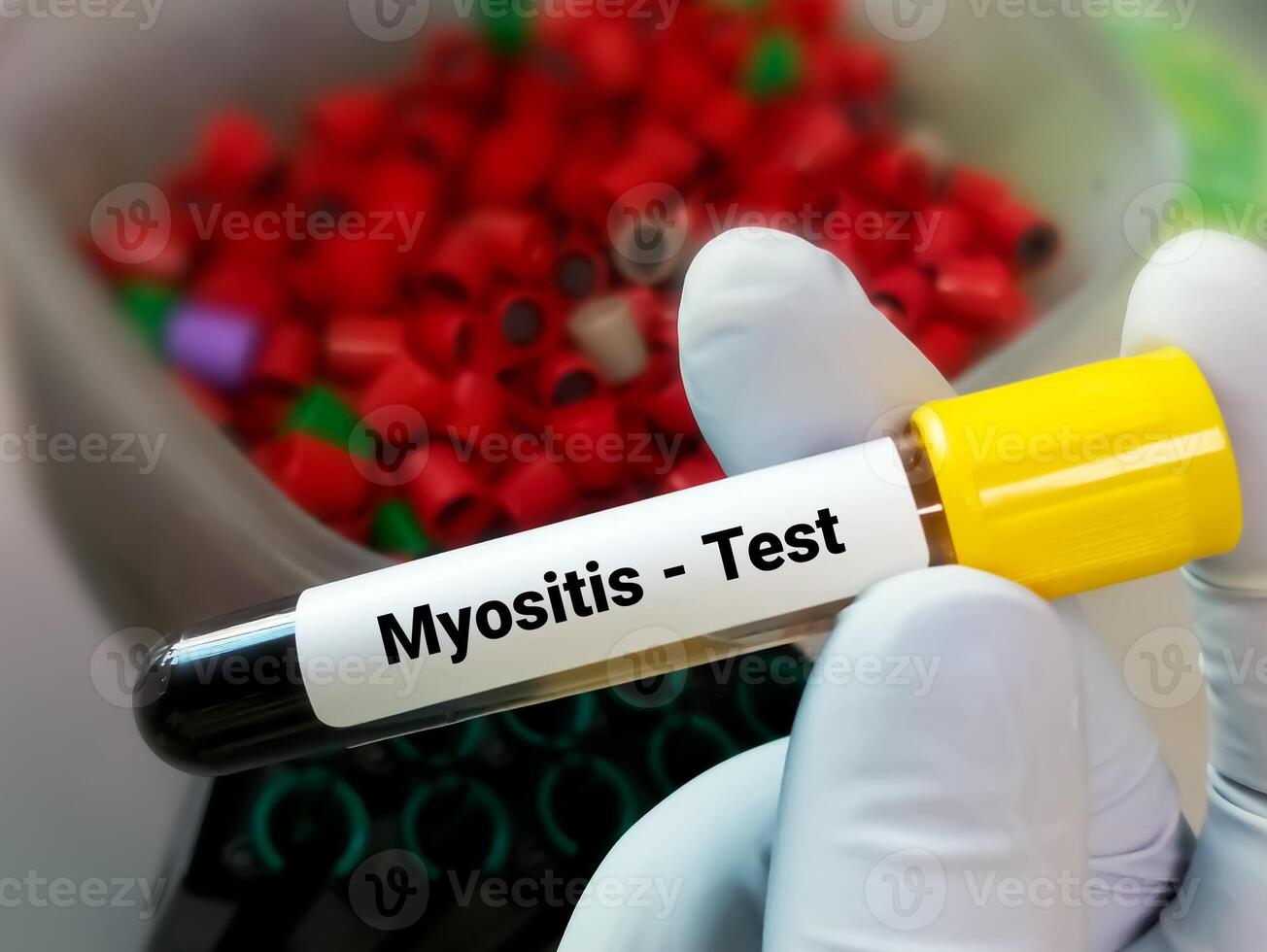 Biochemist holding blood sample for Myositis test. Creatinine Phosphokinase. Creatinine Kinase photo