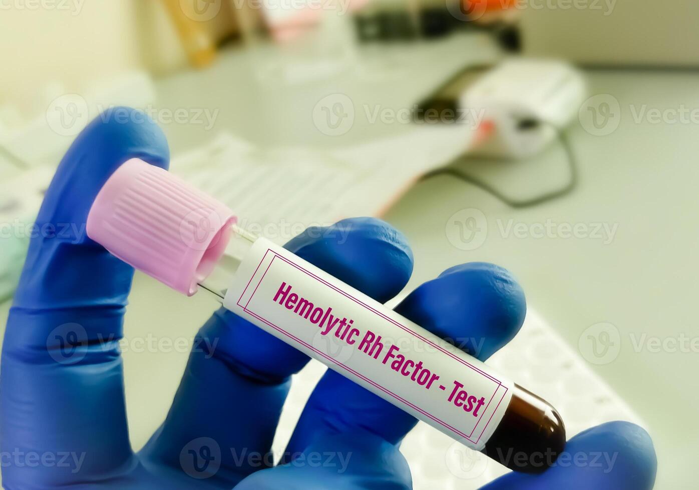 Hemolytic Rh factor test also known as Rh incompatibility or Rh-hemolytic disease test. photo