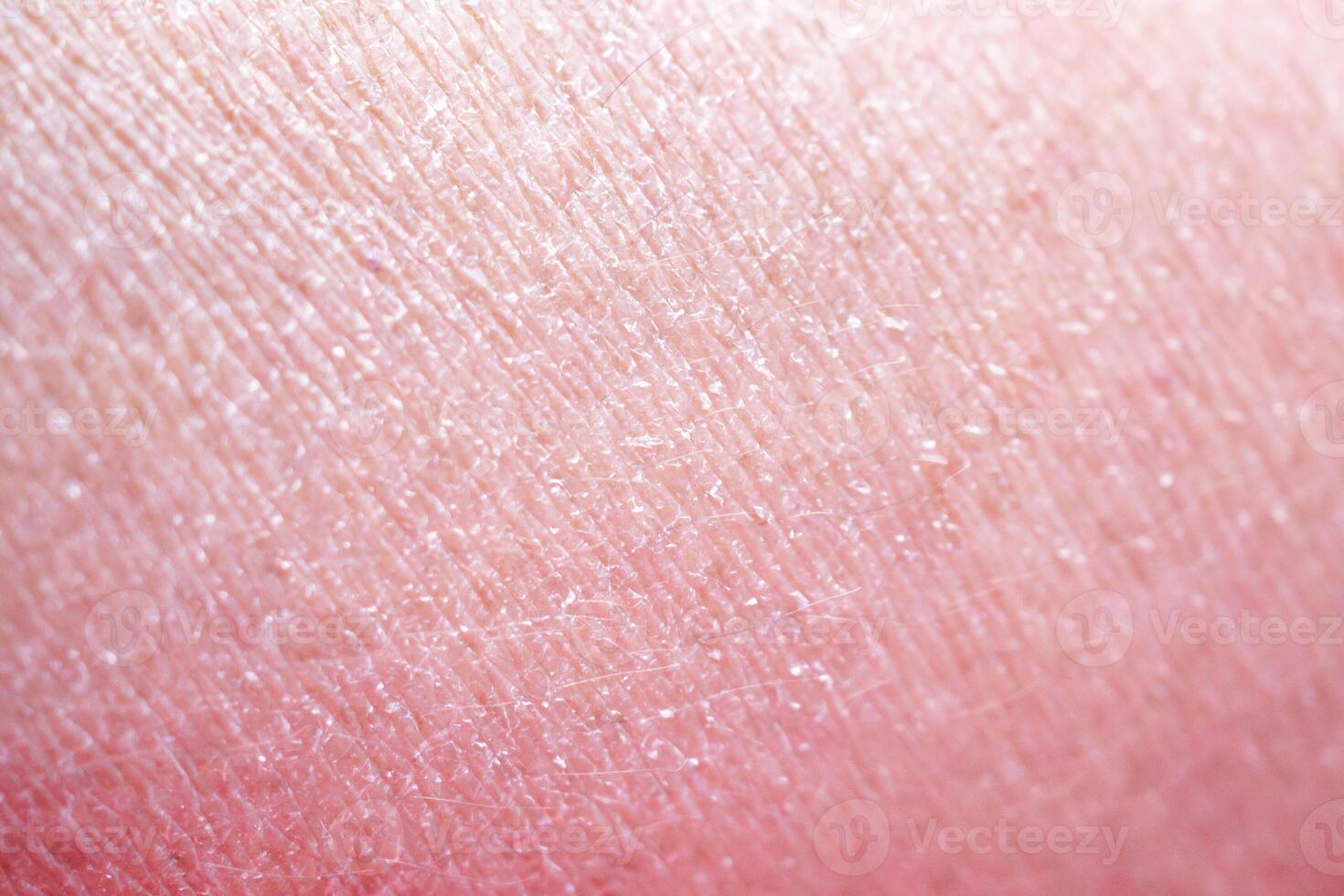 dry and dehydrated human skin texture background photo