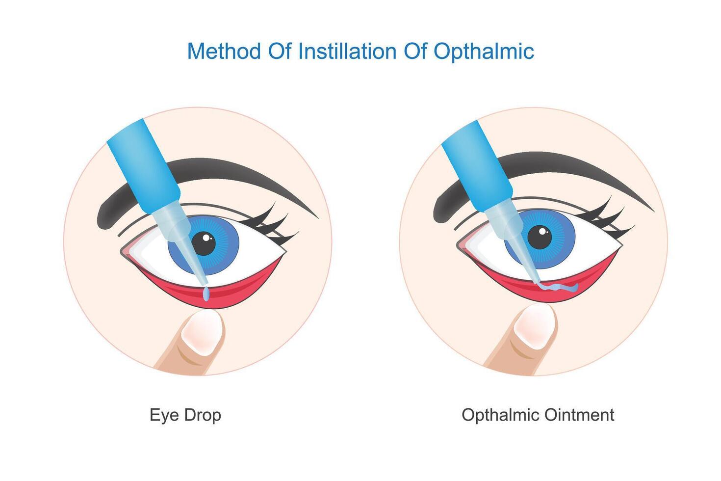 método de instilación de oftálmico. correcto utilizar de ojo gotas y oftálmico ungüento.concepto de ojo tratamiento, ojo inflamación, ojo fatiga, cuidado, visión y salud.vector ilustración. vector