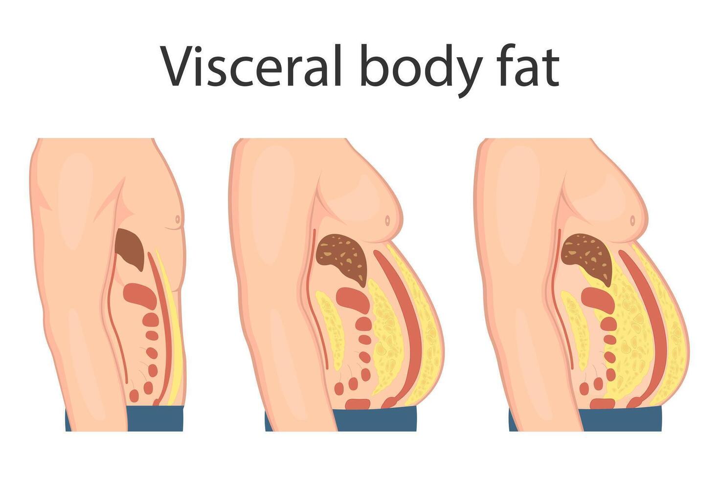 Medical poster about visceral fat. Abdominal fat surrounds the inner doors of the abdominal cavity. Overweight disease concept. Weight loss, liposuction, and diet. vector