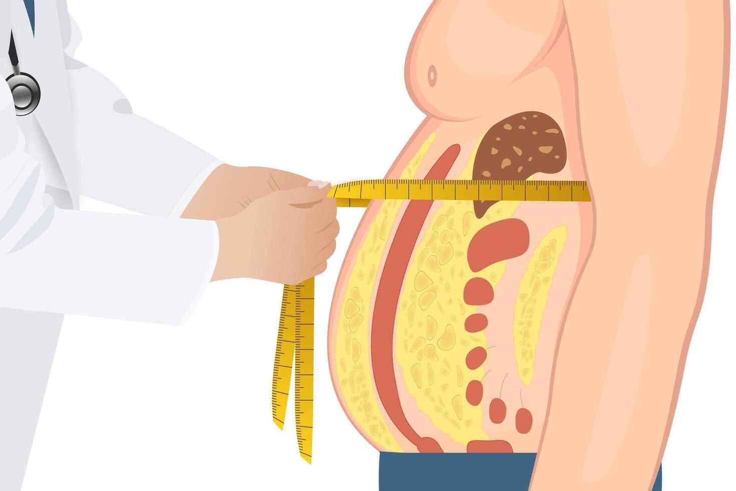 Abdominal fat surrounds the inner doors of the abdominal cavity. Overweight disease concept. Weight loss, liposuction, and diet. vector