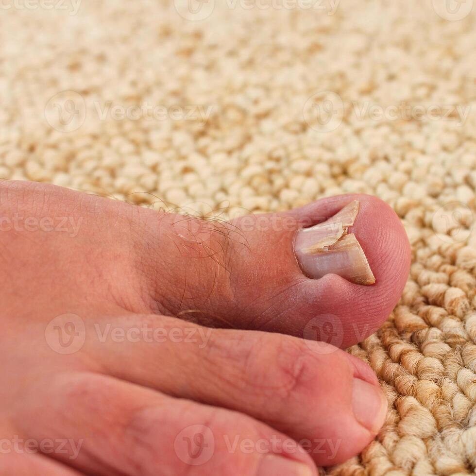 Damaged toenail close-up photo