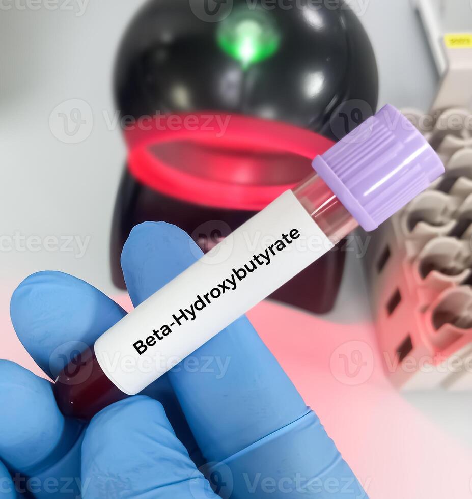 Blood sample for Beta-Hydroxybutyrate or BHB test. used to detect ketones to identify patients suffering from diabetic ketoacidosis. photo