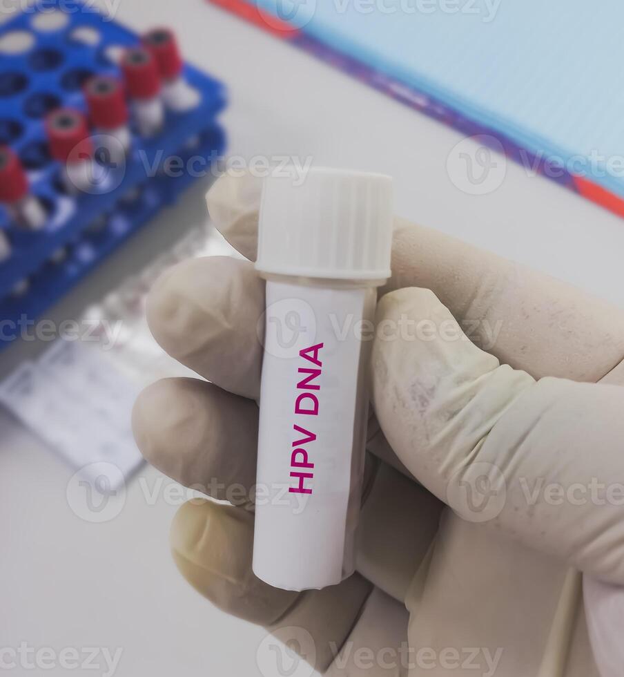 Testing tube with vaginal fluid sample for HPV DNA test, Human papilloma virus, cervical cancer. A medical testing concept in the laboratory photo