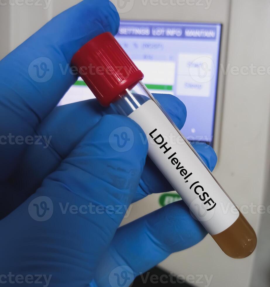 CSF sample for LDH or lactate dehydrogenase test. photo