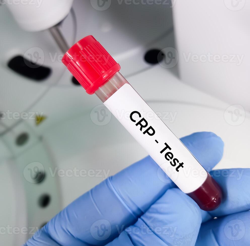 Blood sample for CRP or C reactive protein test used to identify inflammation or infection in the body photo