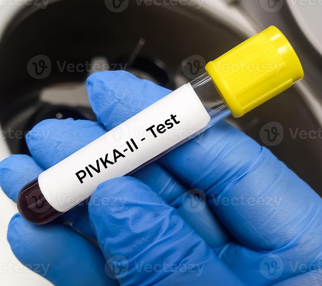 Blood sample for Des gamma carboxy prothrombin or DCP test, to help evaluate whether treatment for one type of liver cancer, hepatocellular carcinoma. photo